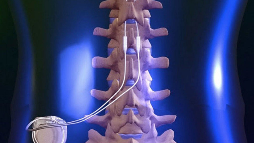 dorsal column stimulator icd 10