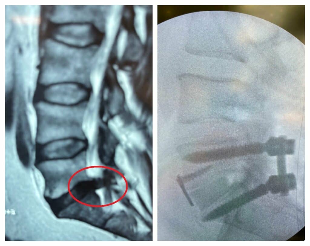 Year Old Patient Update Saspine Surgical Associates In Spine