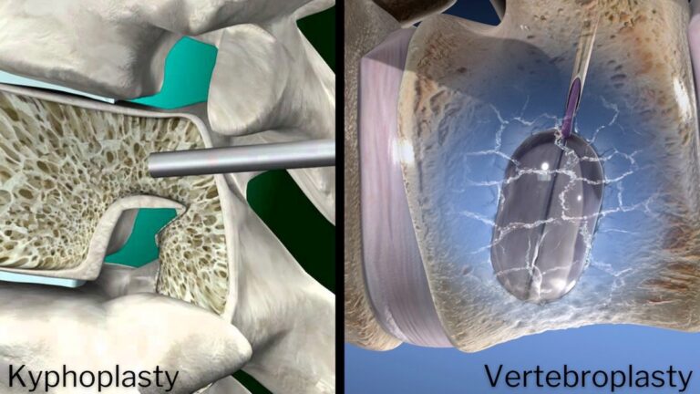 What Are Kyphoplasty Vertebroplasty Surgeries? | SA Spine